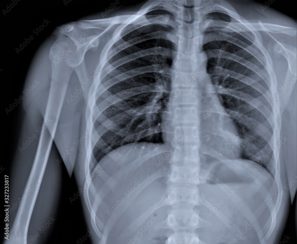 chest x-ray, diagnosis of coronavirus pneumonia chest x-ray, diagnosis of coronavirus pneumonia