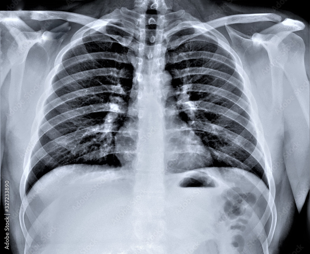 chest x-ray, diagnosis of coronavirus pneumonia chest x-ray, diagnosis of coronavirus pneumonia