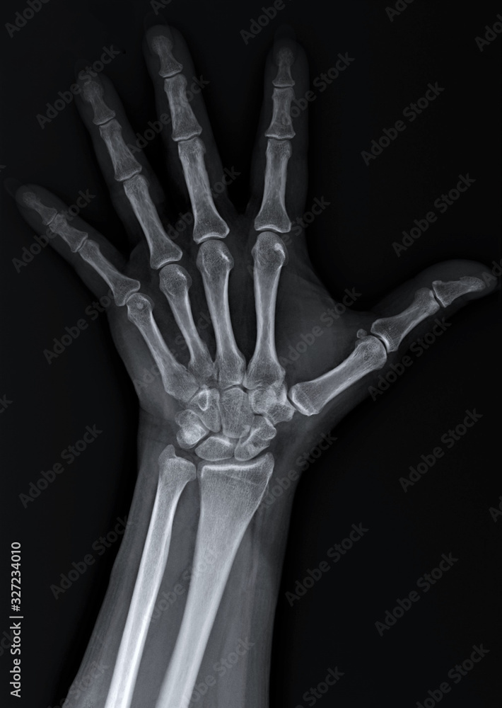 x-ray of the hand and wrist bones x-ray of the hand and wrist bones