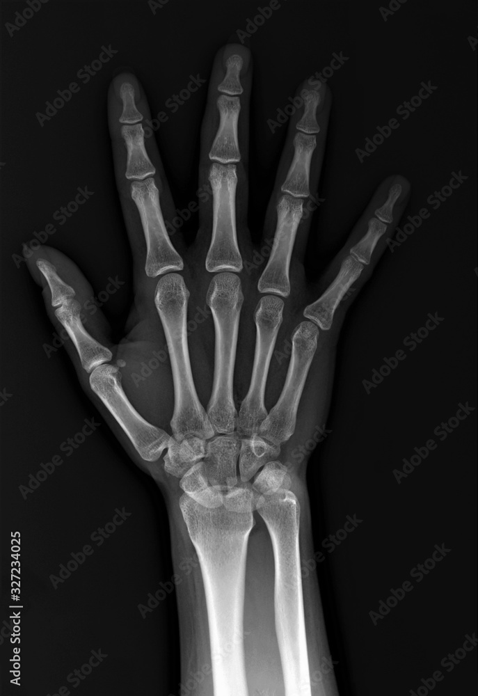 x-ray of the hand and wrist bones x-ray of the hand and wrist bones