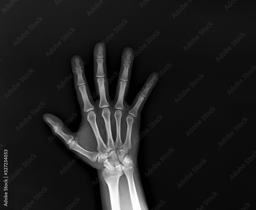 x-ray of the hand and wrist bones x-ray of the hand and wrist bones