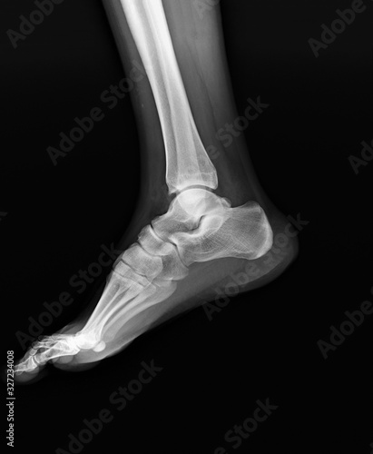 x- ray of the ankle joint in the lateral projection  arthritis  arthrosis