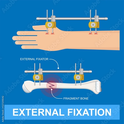 External Fixator treatment broken bone injury accident fracture surgical doctor patient hand arm emergency anatomy sick x-ray tool equipment first aid hospital clinical care health crash injury