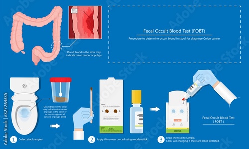 Fecal occult blood test FOBT lab stool sample bleeding screen risk examination collect container Guaiac diagnosis sign hemoccult smear FIT diagnostic