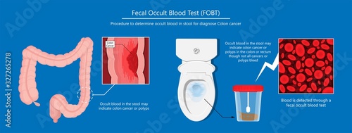 Fecal occult blood test FOBT lab stool sample bleeding screen risk examination collect container Guaiac diagnosis sign hemoccult smear FIT diagnostic