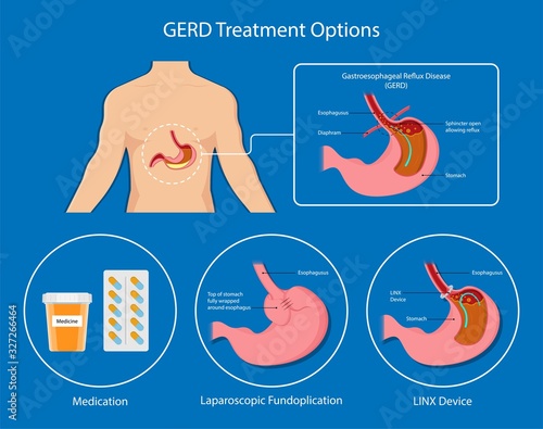 Gastroesophageal reflux disease (GERD) Hiatal Hernia treatment medication