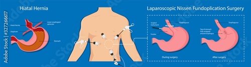 Gastroesophageal reflux disease (GERD) Hiatal Hernia treatment medication