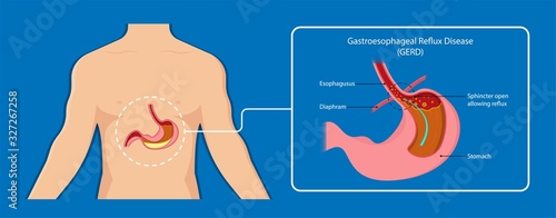 Gastroesophageal reflux disease (GERD) Hiatal Hernia treatment medication