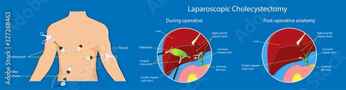 Gallstones cholecystectomy gallbladder removal surgery ultrasound digestive inflamed operative