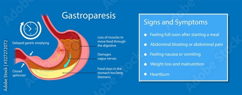 Gastroparesis stomach gastric emptying digestion disease infection Viral Amyloidosis scleroderma disorder gastroesophageal esophagus delayed delay surgery Multiple sclerosis Parkinson gastroenteritis photo
