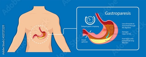 Gastroparesis stomach gastric emptying digestion disease infection Viral Amyloidosis scleroderma disorder gastroesophageal esophagus delayed delay surgery Multiple sclerosis Parkinson gastroenteritis