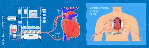 Cardiopulmonary bypass heart lung machine coronary oxygenator perfusiologist cardiologist operating life support artery graft circulation repair mitral tricuspid pulmonic septal defect aneurysms aid