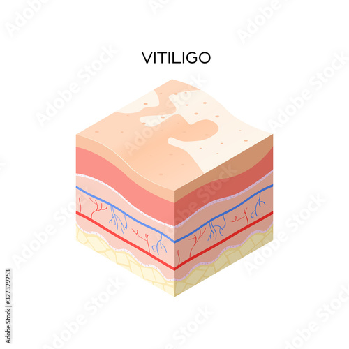 vitiligo skin cross-section of human skin layers structure skincare medical concept flat vector illustration