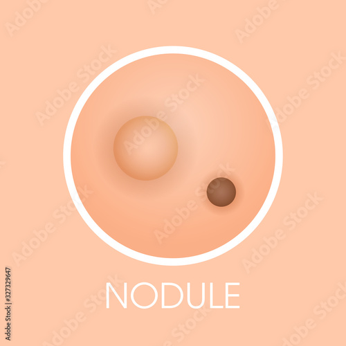 skin nodule pimples acne type face pore comedones cosmetology skincare problems concept flat vector illustration