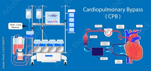 Cardiopulmonary bypass heart lung machine coronary oxygenator perfusiologist cardiologist operating life support artery graft circulation repair mitral tricuspid pulmonic septal defect aneurysms aid