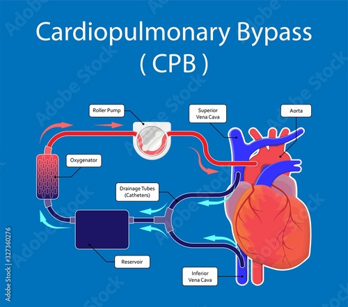Cardiopulmonary bypass heart lung machine coronary oxygenator perfusiologist cardiologist operating life support artery graft circulation repair mitral tricuspid pulmonic septal defect aneurysms aid