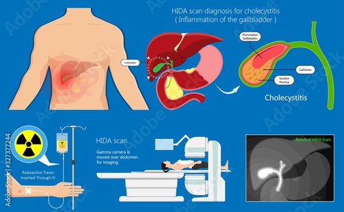 HIDA scan diagnosis treat liver scintigraphy inject cells scanner congenital abnormal leaks test abdomen acute imaging blocked radiology hepatobiliary iminodiacetic acid transplant gallstones 