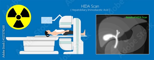 HIDA scan diagnosis treat liver scintigraphy inject cells scanner congenital abnormal leaks test abdomen acute imaging blocked radiology hepatobiliary iminodiacetic acid transplant gallstones 