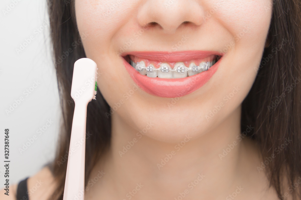 Cleaning teeth with dental braces by pink brush. Happy woman with brackets on the teeth after whitening. Self-ligating brackets with metal ties and gray elastics or rubber bands for perfect smile. Cleaning teeth with dental braces by pink brush. Happy woman with brackets on the teeth after whitening. Self-ligating brackets with metal ties and gray elastics or rubber bands for perfect smile.