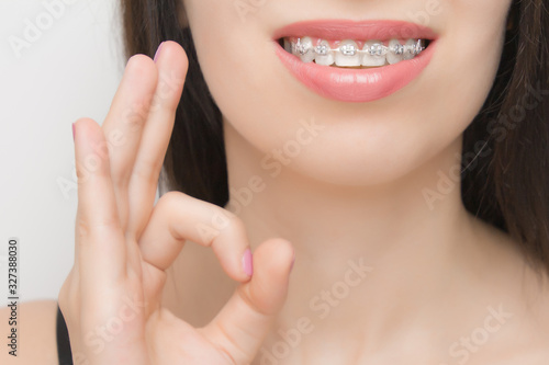 Dental braces in happy womans mouths who shows OK. Brackets on the teeth after whitening. Self-ligating brackets with metal ties and gray elastics or rubber bands for perfect smile. 