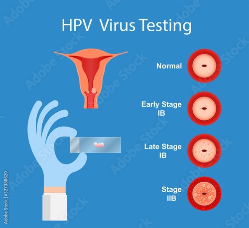 Cervical Cancer Screen Testing Examine Doctor Laboratory Checkup HPV Virus Prevent Staging by Vaginal Speculum detect vaccine