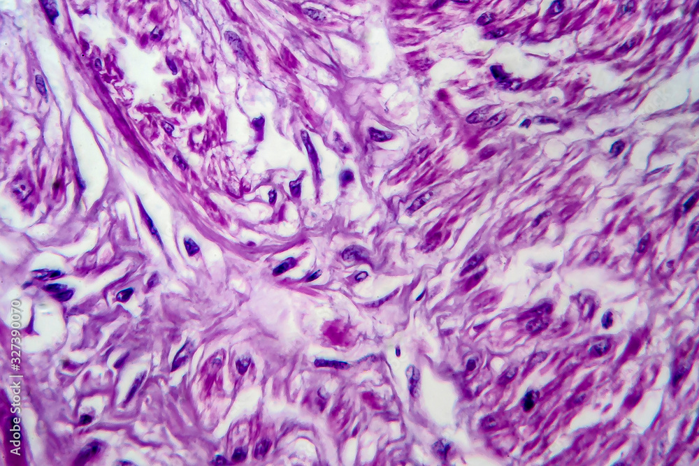 Fototapeta premium Uterine leiomyoma, light micrograph