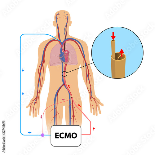 Extracorporeal membrane oxygenation,ecmo in intensive care depar photo