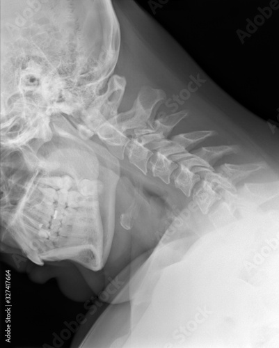 X-ray picture - Cervical spine