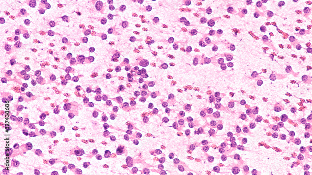 Squash prep cytology smear of a pituitary adenoma, a benign tumor of the pituitary, a hormone producing gland at the base of the brain (alcohol fixed, H&E stain) Squash prep cytology smear of a pituitary adenoma, a benign tumor of the pituitary, a hormone producing gland at the base of the brain (alcohol fixed, H&E stain)