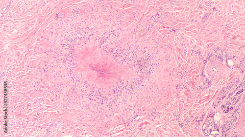 Tablou pe pânză Photomicrograph of a rheumatoid nodule, a firm lump that may develop under the skin in approximately a quarter of patients with rheumatoid arthritis