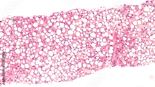 Photomicrograph of liver biopsy histology (pathology) showing steatosis (