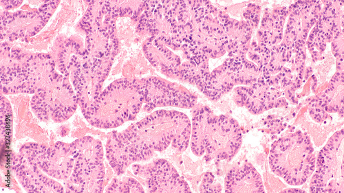 Canvas Print Microscopic image of a pituitary adenoma, a benign tumor of the pituitary, a hormone producing gland at the base of the brain