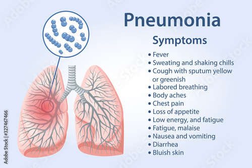Pneumonia symptoms as text. Streptococcus pneumoniae bacteria with magnifying glass in the lungs. Human lungs. Vector illustration in flat style isolated over blue background.