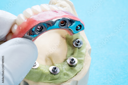 Billede på lærred Dental implant work is completed and ready to use/ dental implant temporary abut