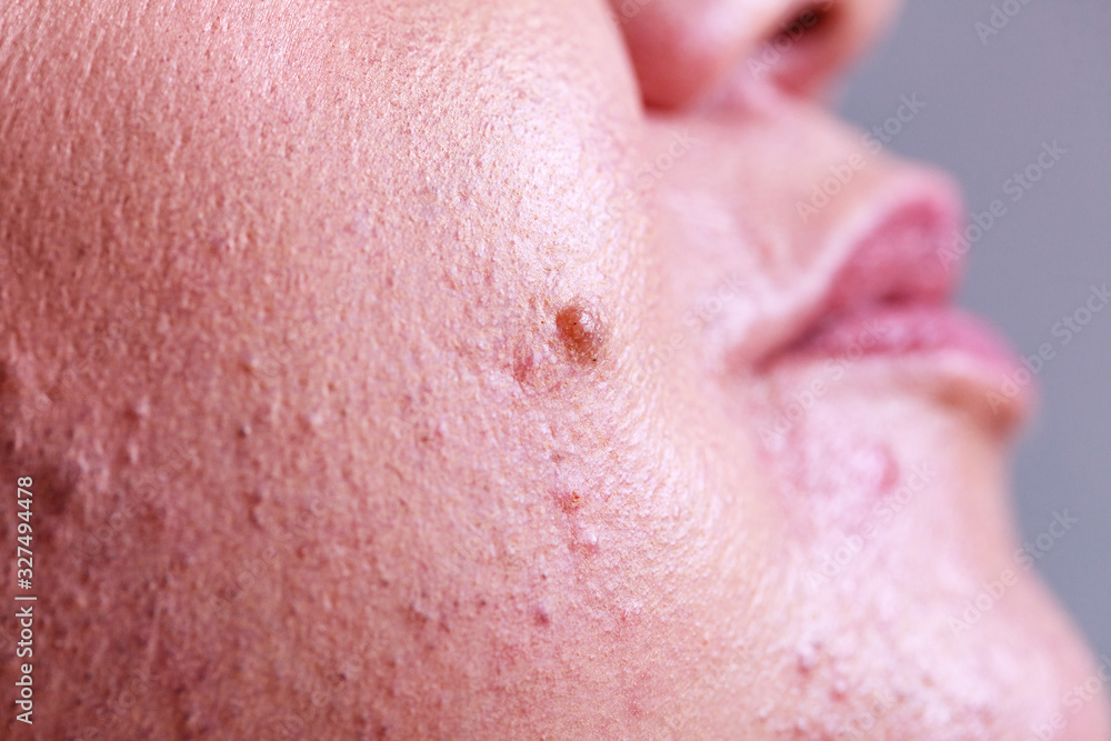 Fototapeta premium Skin face after removing hair