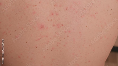 Close-up of chicken pox on the back of an adult male. Adult man who having varicella blister or chickenpox on a back, chicken pox disease.