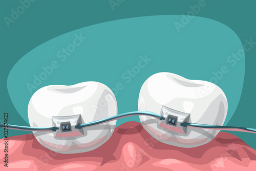 cartoon teeth with steel braces
