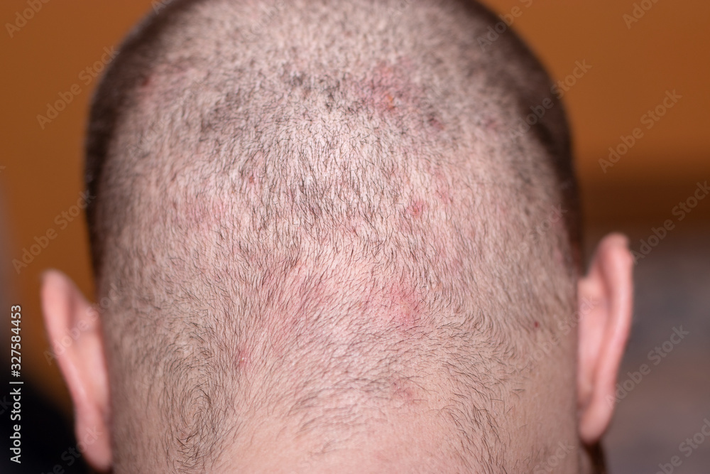 Fototapeta premium Back side of a man's head suffering from scalp acne