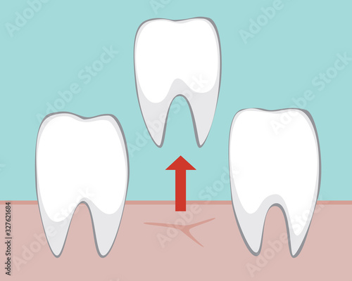 A removal of molars and teeth for design, flat vector stock illustration with a healthy tooth as a concept of dentist services and getting rid of toothache