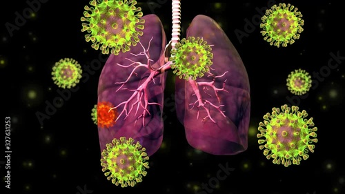 Coronavirus Covid-19 outbreak of contagious infection attacks the lungs