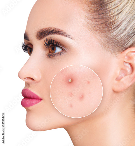 Face of beautiful woman with zoom circle before and after acne treatment.