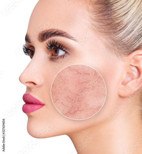 Zoom circle shows couperose on face skin of young woman.