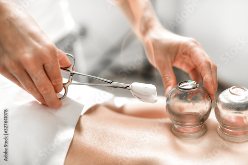 Detail of a woman therapist hands giving cupping treatment on back.