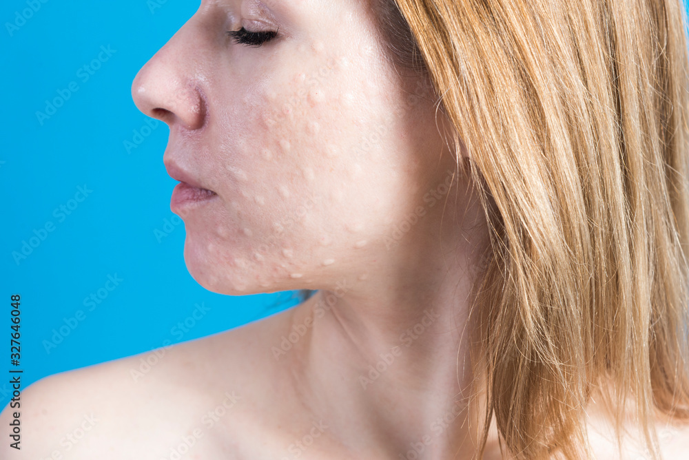 Biorevitalization of real skin. Traces of biorevitalization injections on a woman's face Biorevitalization of real skin. Traces of biorevitalization injections on a woman's face