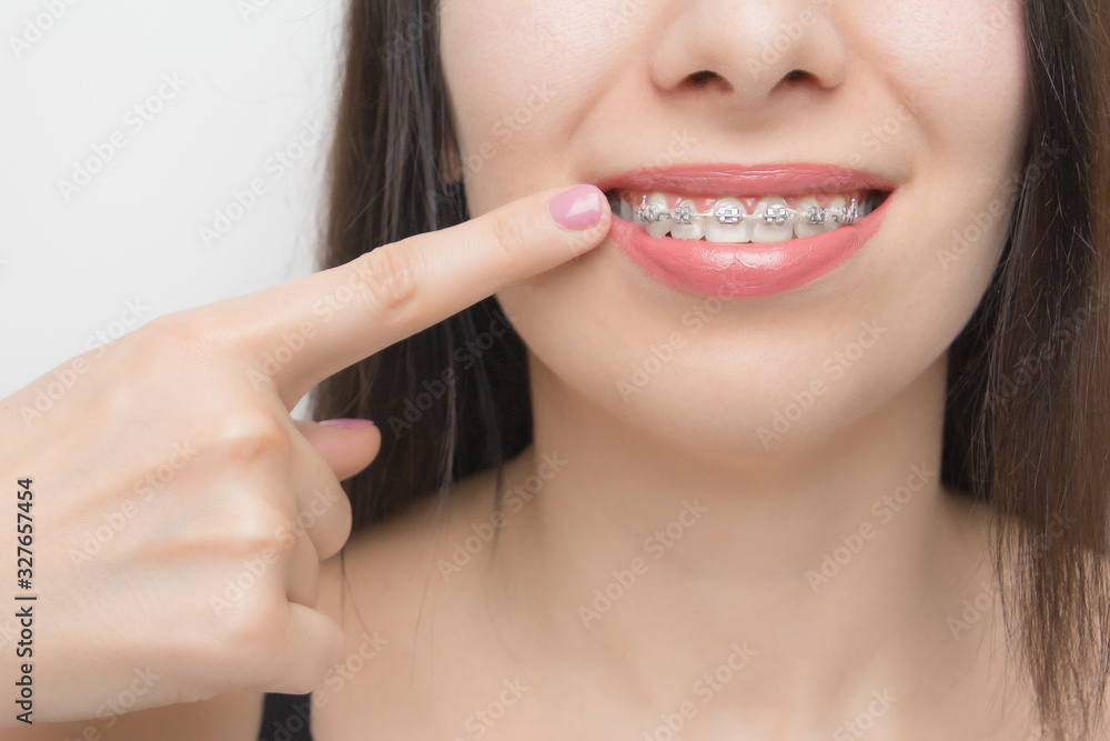 Dental braces in happy womans mouths who shows by finger on brackets on the teeth after whitening. Self-ligating brackets with metal ties and gray elastics or rubber bands for perfect smile Dental braces in happy womans mouths who shows by finger on brackets on the teeth after whitening. Self-ligating brackets with metal ties and gray elastics or rubber bands for perfect smile