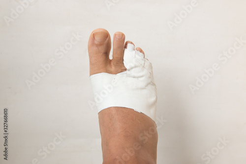 Photography Close up of a Man’s bandaged up broken toe