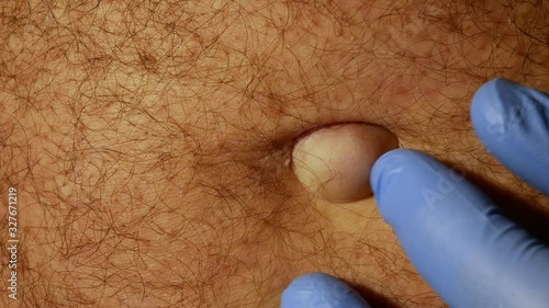 Medical examination of the patient's umbilical hernia of the abdomen