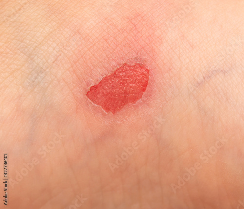 red leg wound © studybos