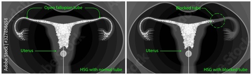 Hysterosalpingogram (HSG) Test Blocked Fallopian Tubes diagnose tubal factor infertility pregnant trouble certain sexually transmitted structural abnormalities uterine exam liquid fluoroscope cancer