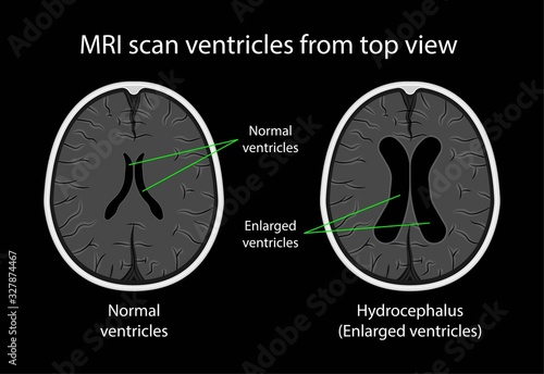 Hydrocephalus brain cerebrospinal fluid  (CSF) drain head